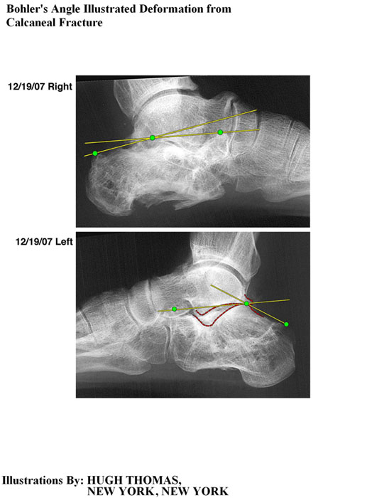 Bohler's Angle Illustrated Deformation from Calcaneal Fracture