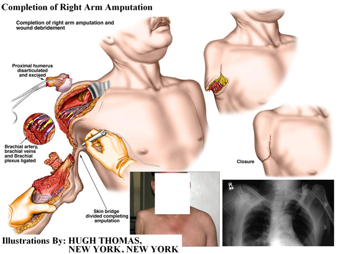 Completion of Right Arm Amputation