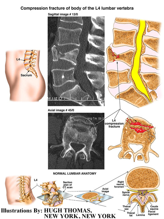 Compression Fracture of body of the L4 Lumbar Vertebra