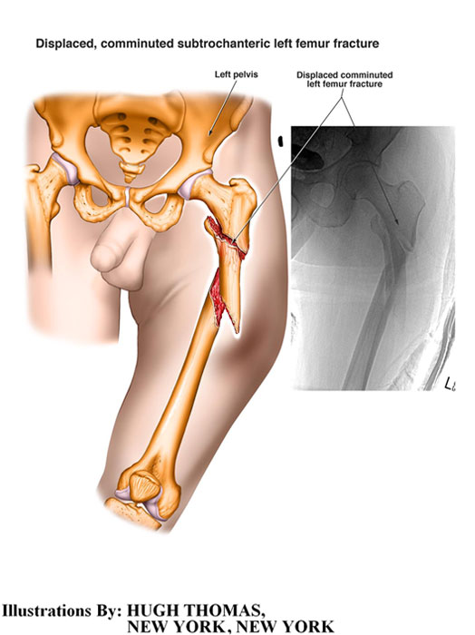 Displaced, comminuted subtrochateric left femur fracture