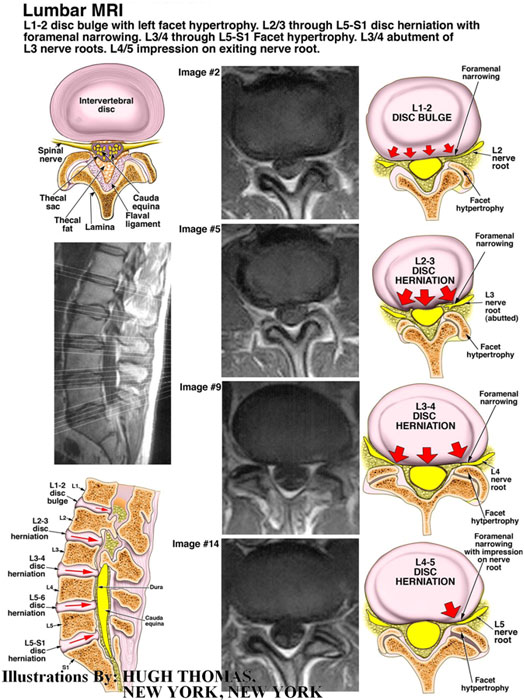 Lumbar MRI - L1-2 disc bulge with left facet hypertrophy