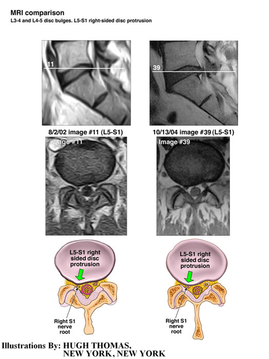 MRI comparison - L3-4 and L4-5 bulges