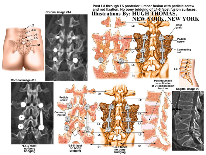 Post L3 through L5 posterior lumbar fusion with pedicle screw and rod fixation