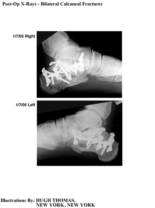 Post-Op X-Rays - Bilateral Calcaneal Fractures