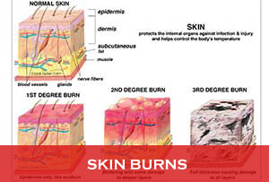 Skin-Burns