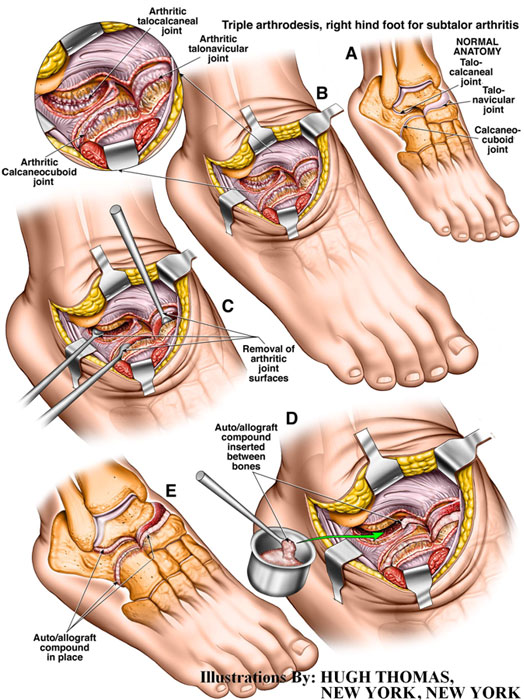 Triple arthrodesis, right hind foot for subtalor arthritis