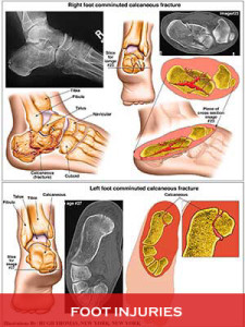 Foot-Injuries