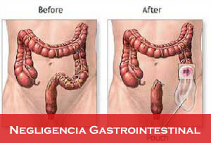 Negligencia-Gastrointestinal